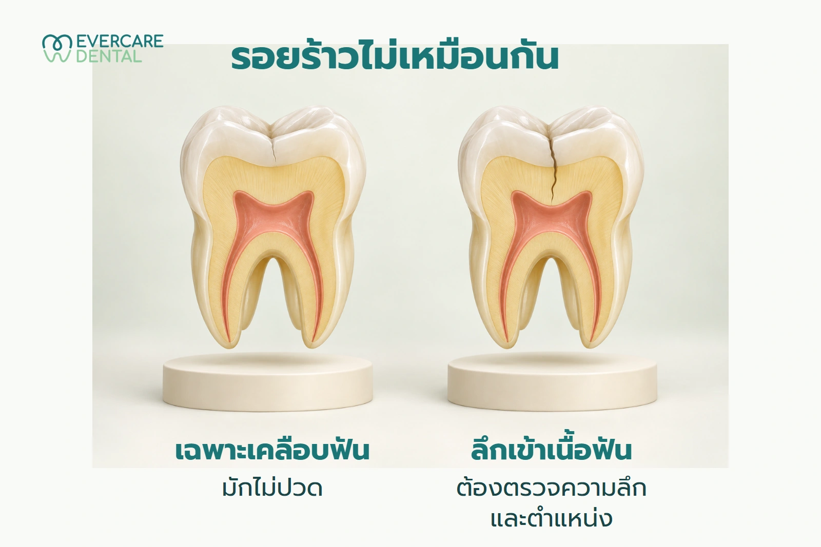 โมเดลฟันจำลองสองแบบ เปรียบเทียบเส้นร้าวตื้นเฉพาะเคลือบฟันกับรอยที่ลึกเข้าเนื้อฟัน เป็นภาพแนวคิด ไม่ใช่ผลตรวจหรือภาพก่อนและหลัง