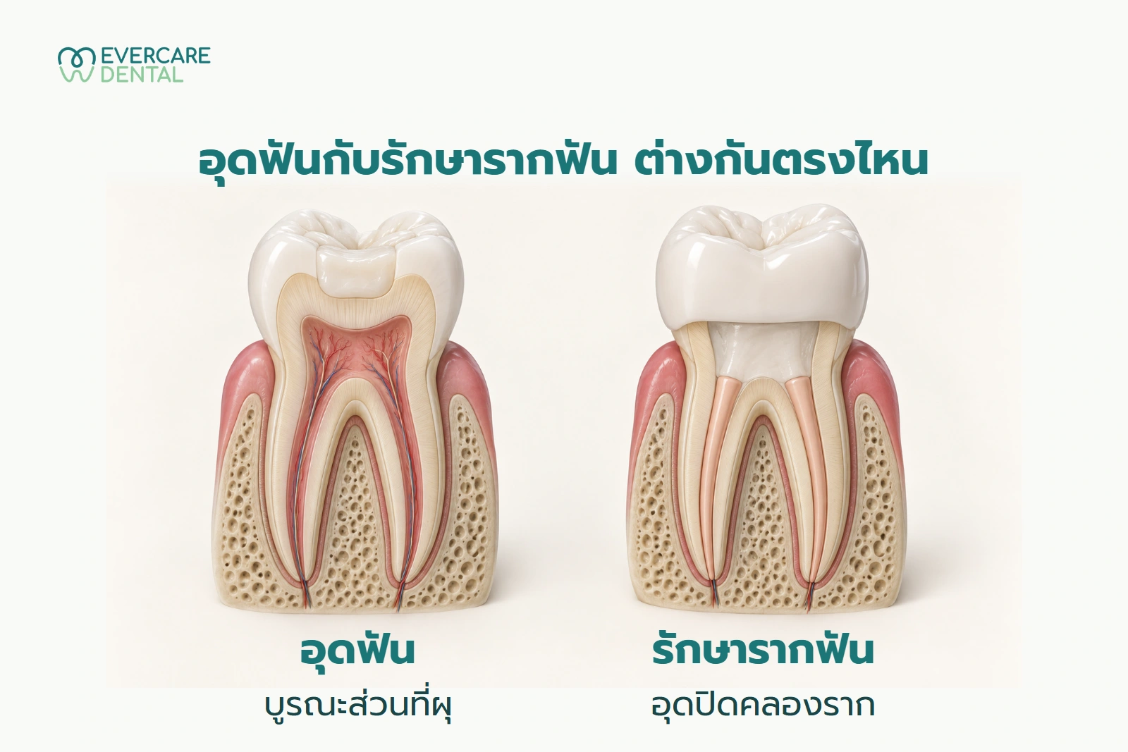 เปรียบเทียบโมเดลฟันสมมติสองซี่: อุดฟันบูรณะส่วนที่ผุ และรักษารากฟันอุดปิดคลองราก ไม่ใช่ภาพก่อนและหลังของผู้ป่วย
