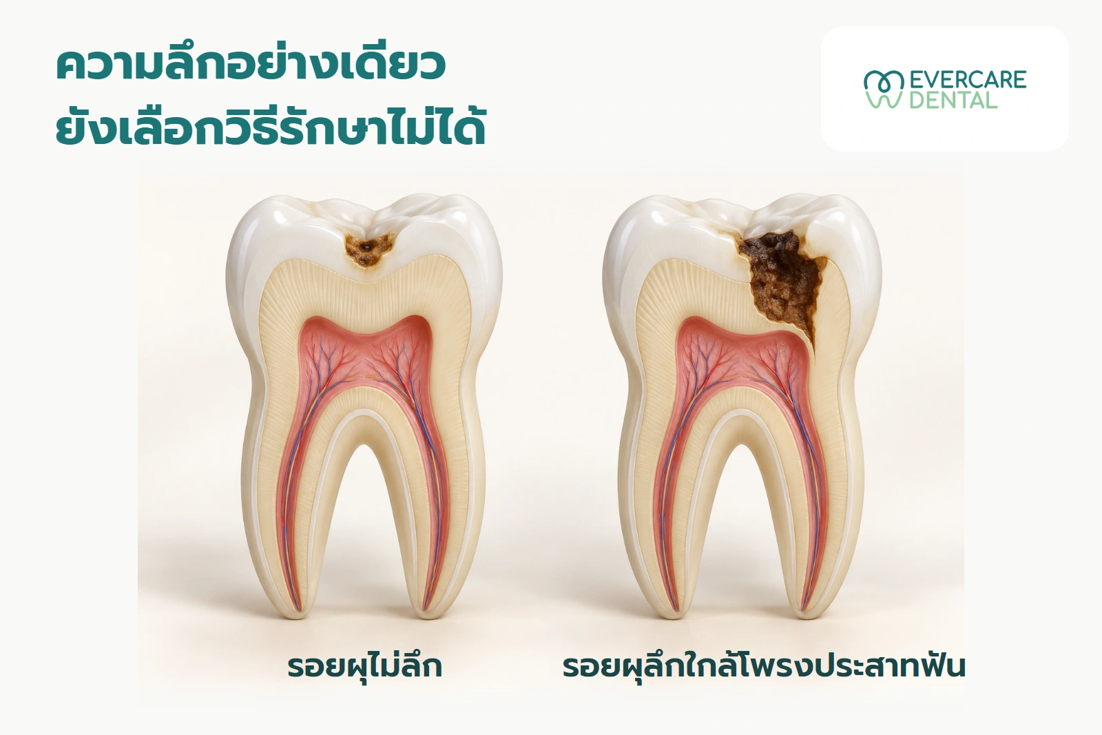 โมเดลฟันตัดขวางเชิงแนวคิดสองซี่ เปรียบเทียบรอยผุที่ห่างและใกล้โพรงประสาทฟัน ความลึกอย่างเดียวยังเลือกวิธีรักษาไม่ได้