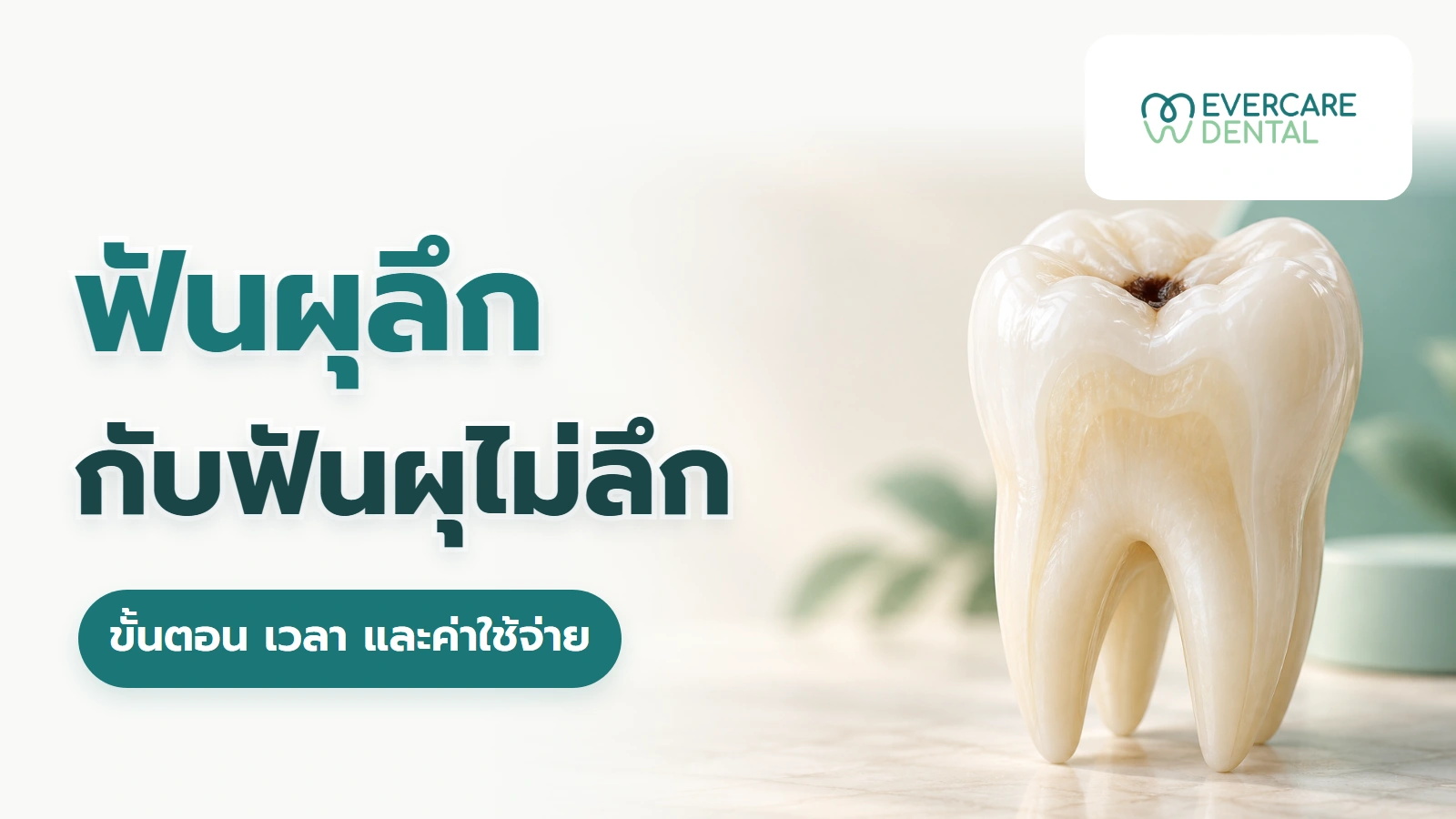 ฟันผุลึกกับฟันผุไม่ลึก: ขั้นตอน เวลา และค่าใช้จ่ายต่างกันอย่างไร ภาพจำลองฟันประกอบหัวข้อเปรียบเทียบฟันผุลึกกับฟันผุไม่ลึก ขั้นตอน เวลา และค่าใช้จ่าย