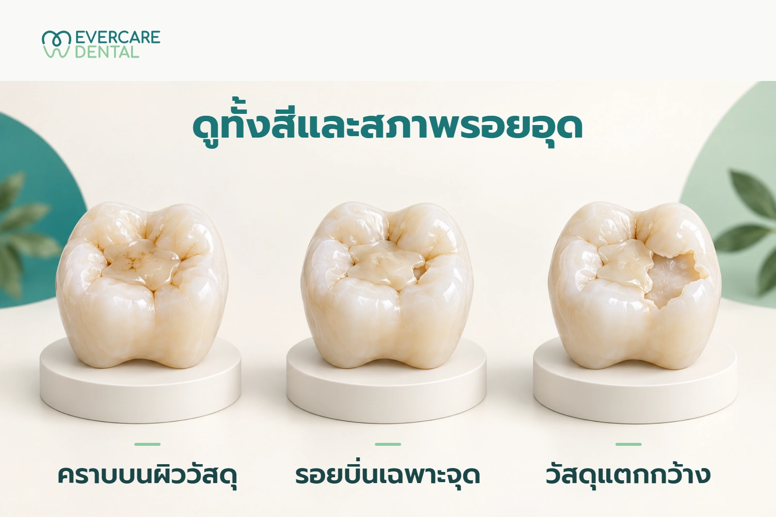 โมเดลฟันสามมิติจำลองสามแบบ แสดงคราบบนผิววัสดุ รอยบิ่นเฉพาะจุด และวัสดุแตกกว้าง ไม่ใช่ภาพวินิจฉัยฟันผุหรือผลรักษา