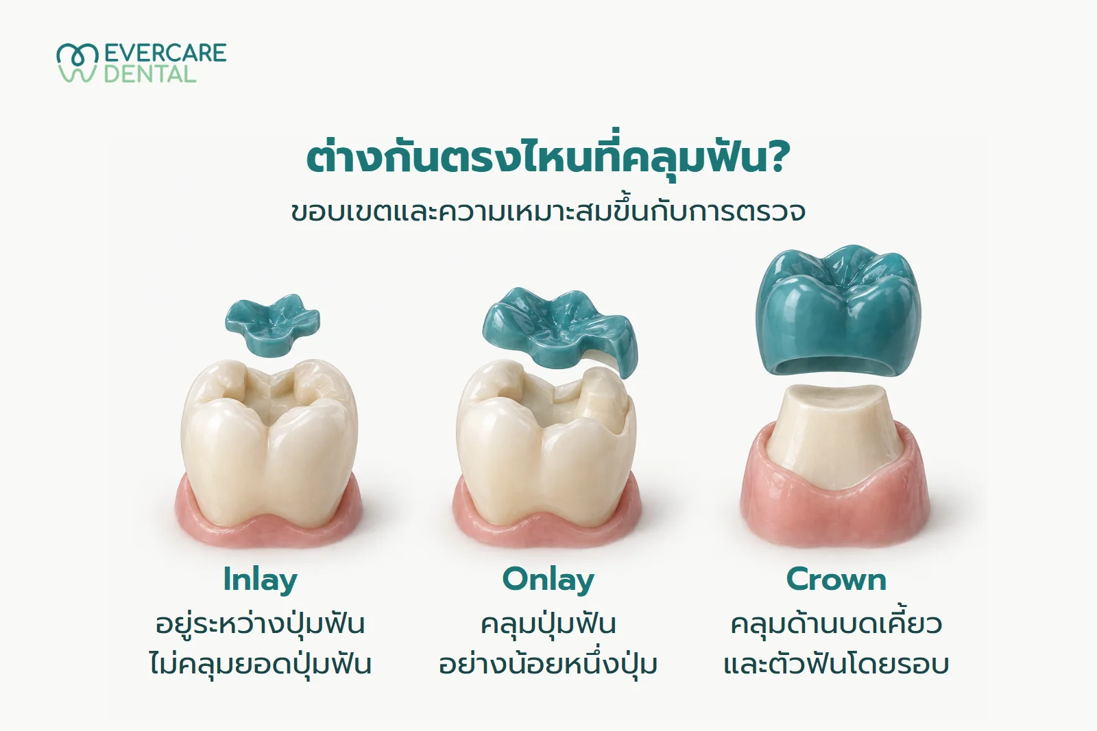 ภาพจำลอง AI เปรียบเทียบ Inlay ระหว่างปุ่มฟัน Onlay คลุมปุ่มฟันอย่างน้อยหนึ่งปุ่ม และ Crown คลุมตัวฟันโดยรอบ
