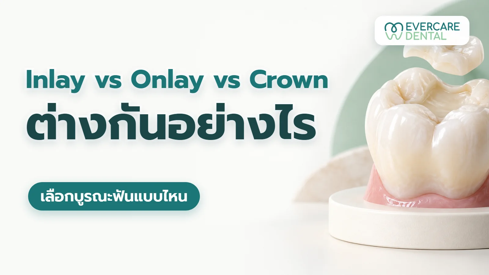 Inlay vs Onlay vs Crown ต่างกันอย่างไร เลือกบูรณะฟันแบบไหน