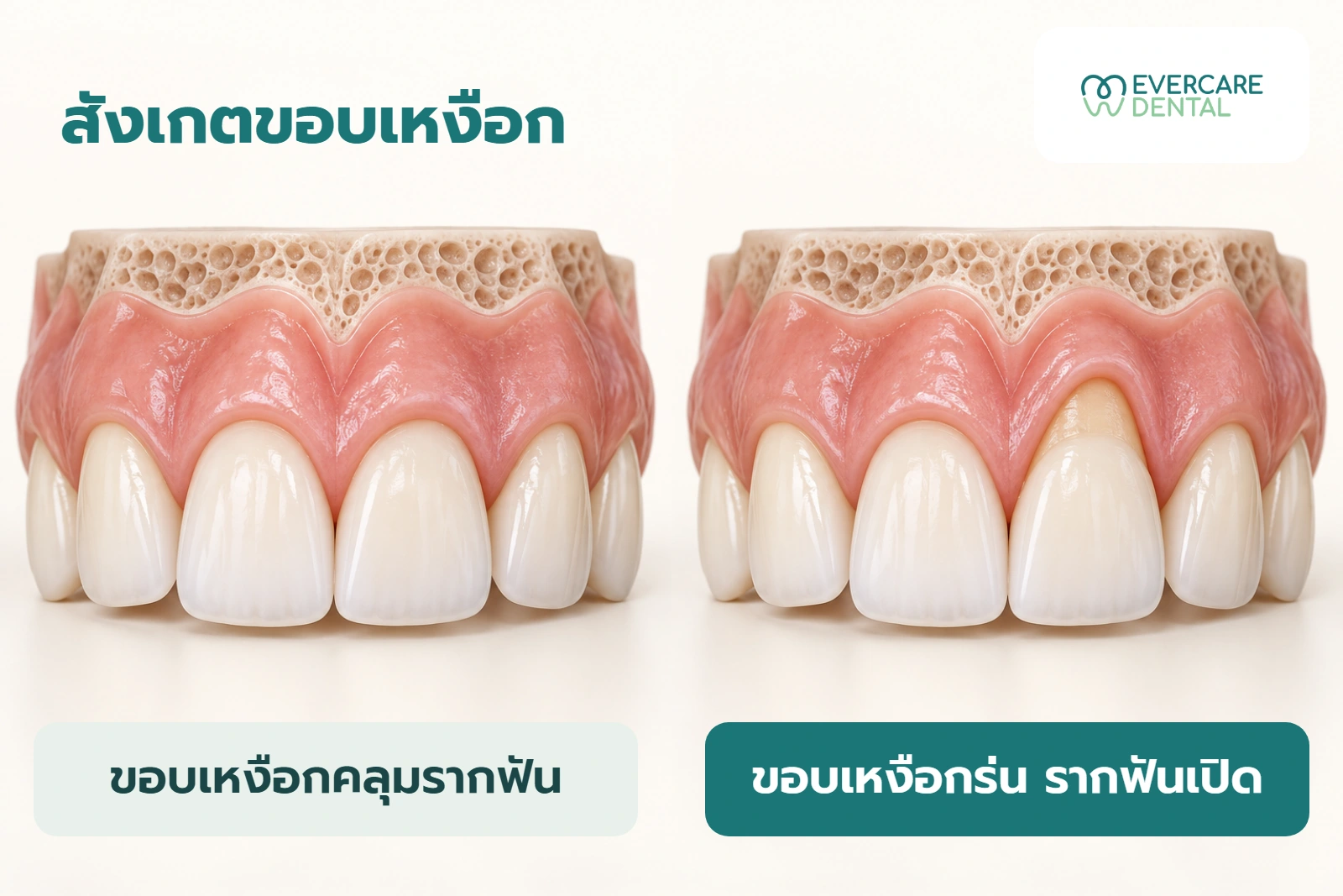 โมเดลฟันจำลองสองชุด เปรียบเทียบขอบเหงือกคลุมรากฟันกับขอบเหงือกร่นที่เห็นรากฟันบางส่วน