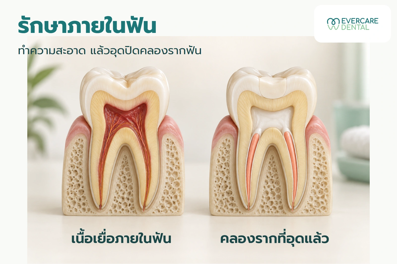 แบบจำลองฟันตัดขวางสองแบบ แสดงเนื้อเยื่อภายในฟันและคลองรากที่อุดแล้ว เป็นภาพแนวคิดประกอบบทความ ไม่ใช่ผลรักษาจริง