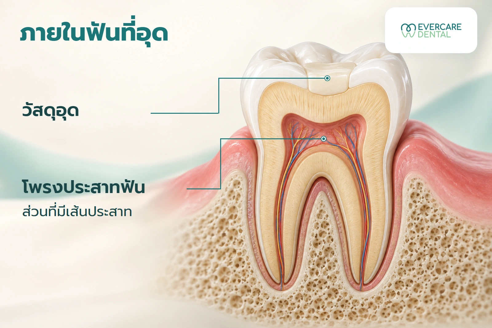 ภาพตัดขวางโมเดลฟันกรามสมมติหนึ่งซี่ แสดงวัสดุอุดบริเวณด้านบดเคี้ยวและโพรงประสาทฟัน เป็นภาพแนวคิดเพื่อประกอบความเข้าใจ
