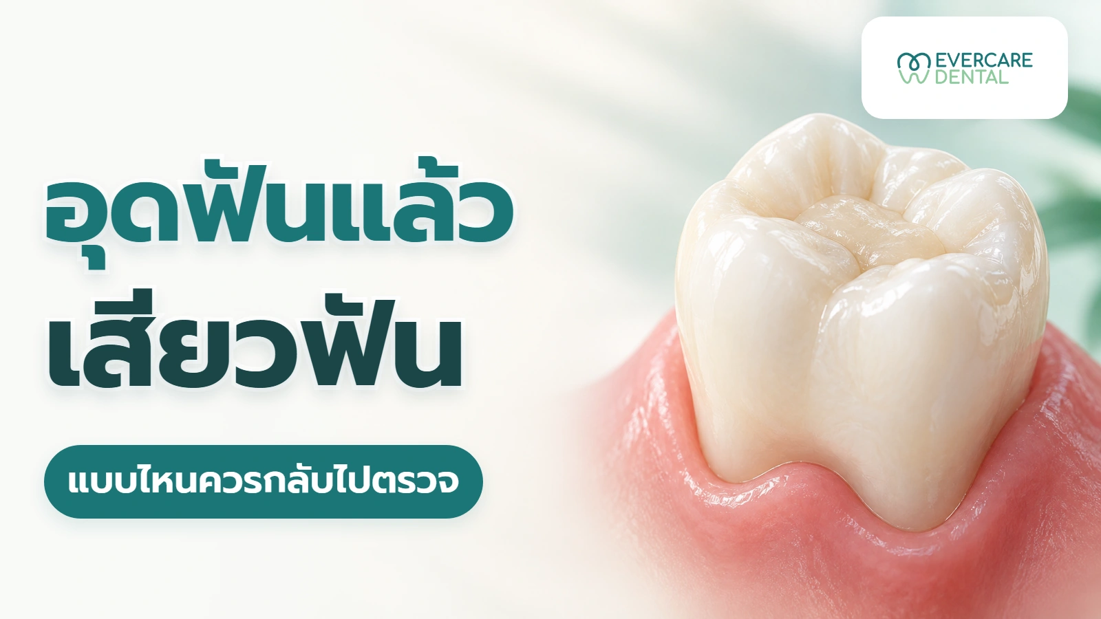 อุดฟันแล้วเสียวฟัน แบบไหนเฝ้าดูได้ และแบบไหนควรกลับไปตรวจ ภาพโมเดลฟันกรามสมมติที่มีวัสดุอุดสีเหมือนฟัน ประกอบหัวข้ออุดฟันแล้วเสียวฟัน แบบไหนควรกลับไปตรวจ