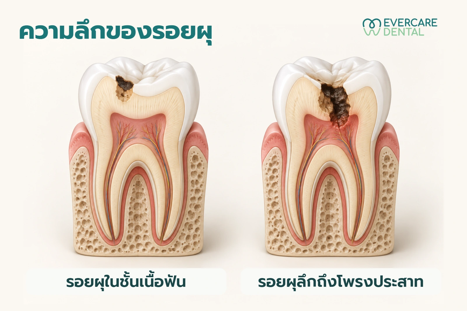 โมเดลฟันจำลองสองซี่เปรียบเทียบรอยผุในชั้นเนื้อฟันกับรอยผุลึกถึงโพรงประสาท ไม่ใช่ภาพวินิจฉัยของผู้ป่วย