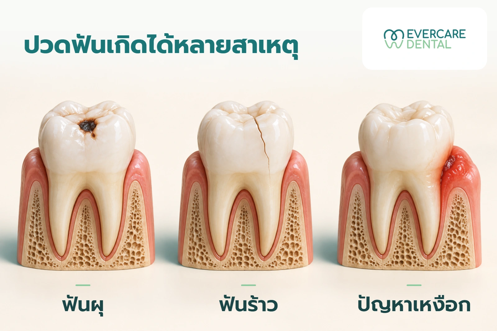 โมเดลฟันเชิงแนวคิดสามชิ้น แสดงตัวอย่างฟันผุ ฟันร้าว และเหงือกบวมแดง ภายใต้หัวข้อปวดฟันเกิดได้หลายสาเหตุ