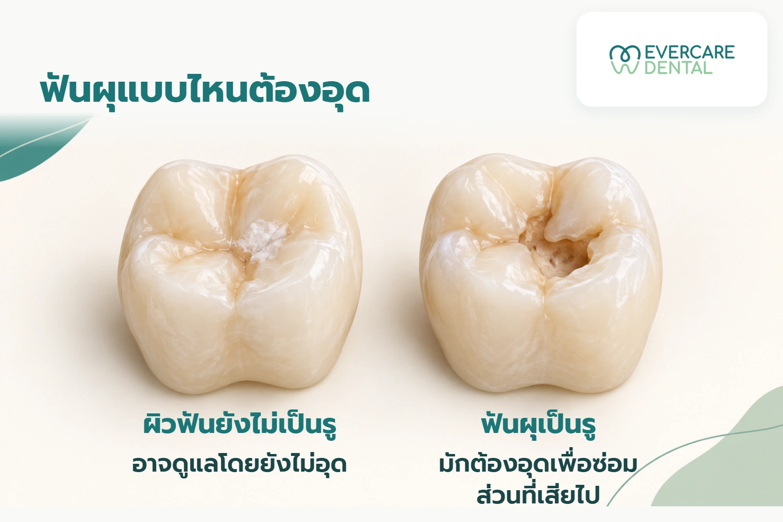 โมเดลฟันจำลองสองซี่ เปรียบเทียบผิวฟันที่ยังไม่เป็นรูกับฟันผุเป็นรู พร้อมแนวทางดูแลที่มีเงื่อนไข ภาพไม่แสดงความลึกภายในฟัน