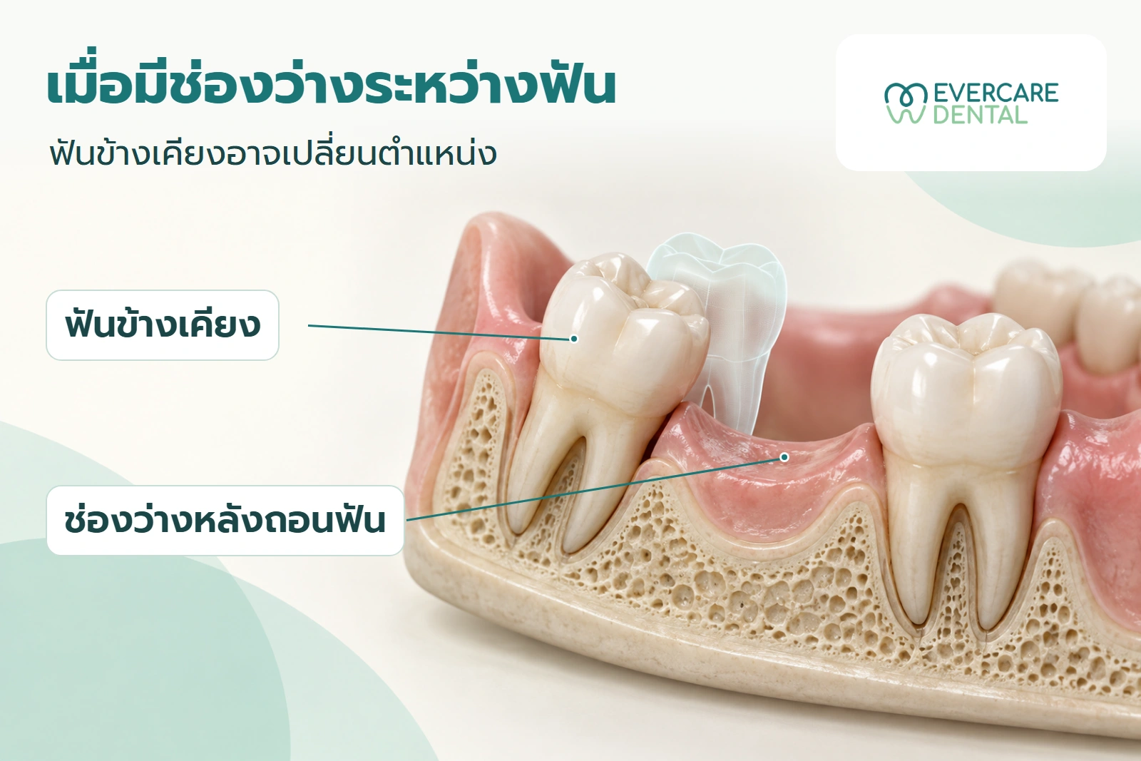 ภาพจำลองฟันข้างเคียง ช่องว่างหลังถอน และเงาตำแหน่งฟัน ประกอบคำอธิบายว่าฟันอาจเปลี่ยนตำแหน่ง