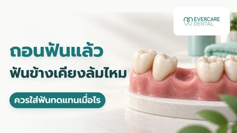 ถอนฟันแล้วฟันข้างเคียงล้มไหม ควรใส่ฟันทดแทนเมื่อไร ภาพจำลองแถวฟันที่มีช่องว่างหลังถอน ประกอบคำถามเรื่องฟันข้างเคียงและการใส่ฟันทดแทน
