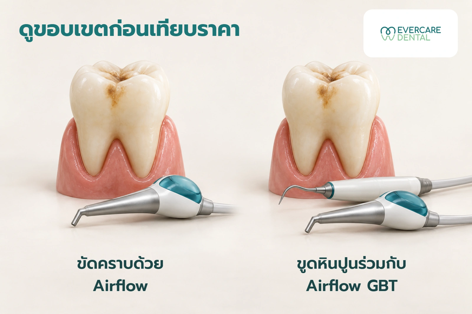 ภาพประกอบเชิงแนวคิดเปรียบเทียบขอบเขตขัดคราบด้วย Airflow กับขูดหินปูนร่วมกับ Airflow GBT ด้วยโมเดลฟันและเครื่องมือ ไม่ใช่ภาพก่อน–หลัง