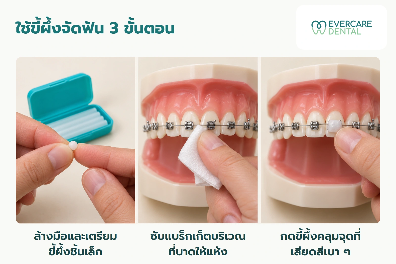 ภาพจำลองสามขั้นตอนด้วยมือผู้ใหญ่สมมติและโมเดลฟัน: เตรียมขี้ผึ้งชิ้นเล็ก ซับแบร็กเก็ต และกดขี้ผึ้งคลุมแบร็กเก็ตเบา ๆ ไม่ใช่ภาพหัตถการในผู้ป่วยจริง
