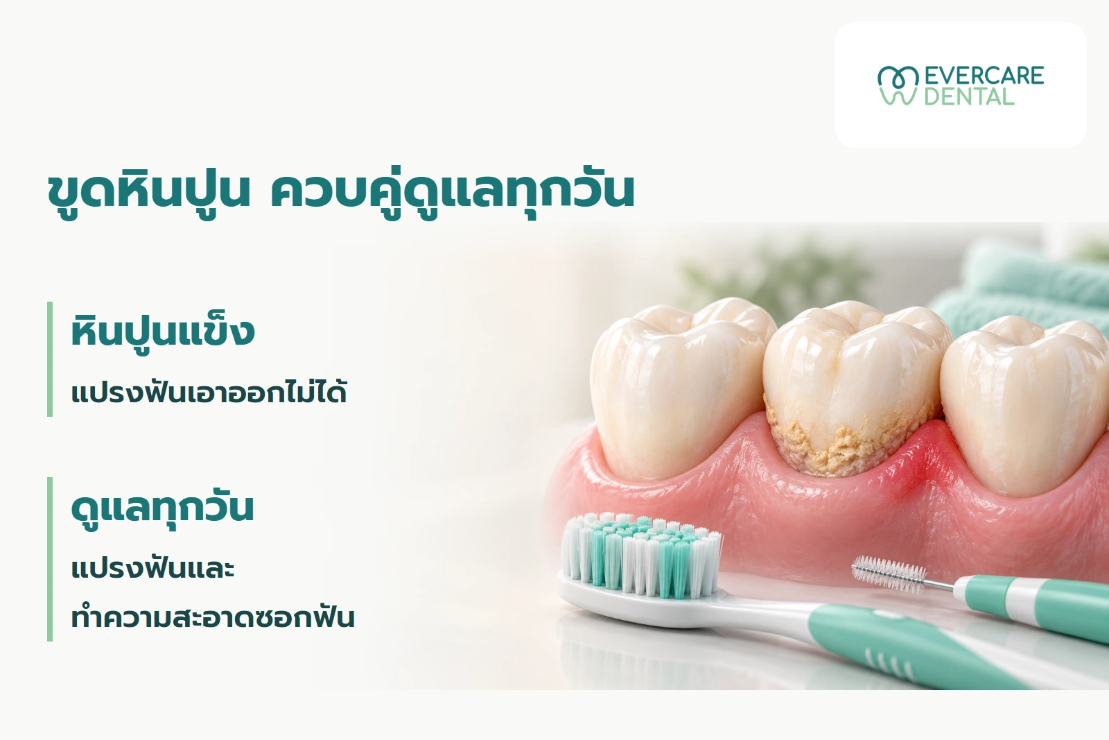 โมเดลฟันและเหงือกจำลองที่มีคราบหินปูน พร้อมแปรงสีฟันและแปรงซอกฟัน ประกอบการอธิบายว่าหินปูนแข็งแปรงเอาออกไม่ได้ และต้องดูแลความสะอาดทุกวัน