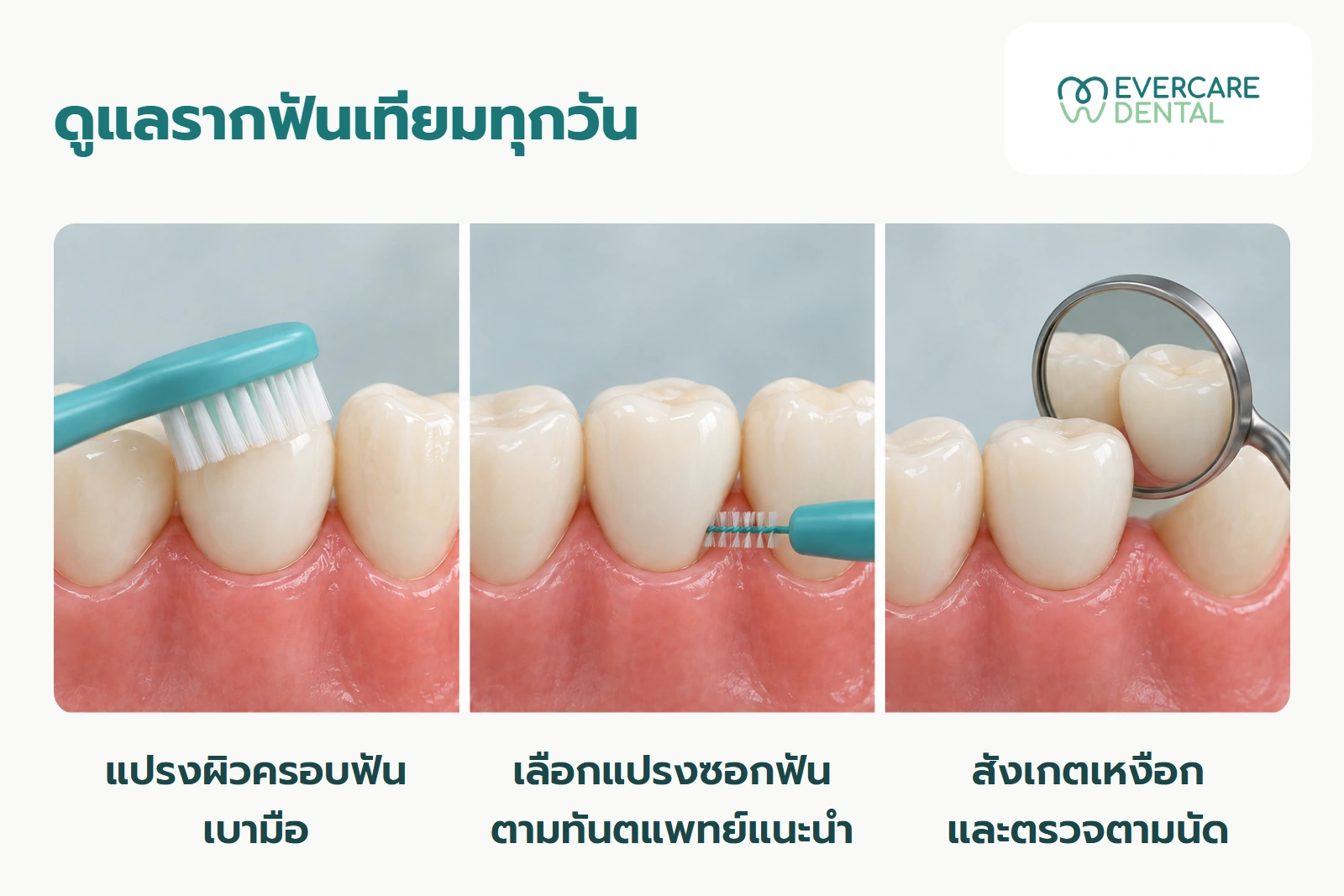 ภาพจำลองสามช่องแสดงแปรงสีฟันบนผิวครอบฟัน แปรงซอกฟันบริเวณข้างครอบฟัน และกระจกตรวจฟัน