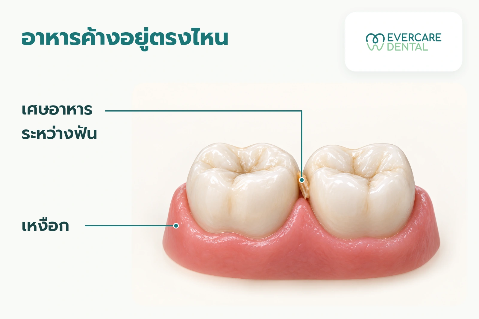ภาพจำลองฟันกรามสองซี่ มีเศษอาหารค้างระหว่างฟัน พร้อมป้ายชี้เศษอาหารและเหงือก