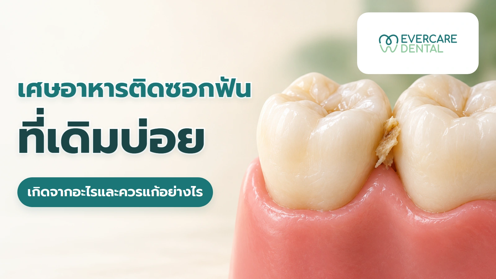 เศษอาหารติดซอกฟันที่เดิมบ่อย เกิดจากอะไรและควรแก้อย่างไร