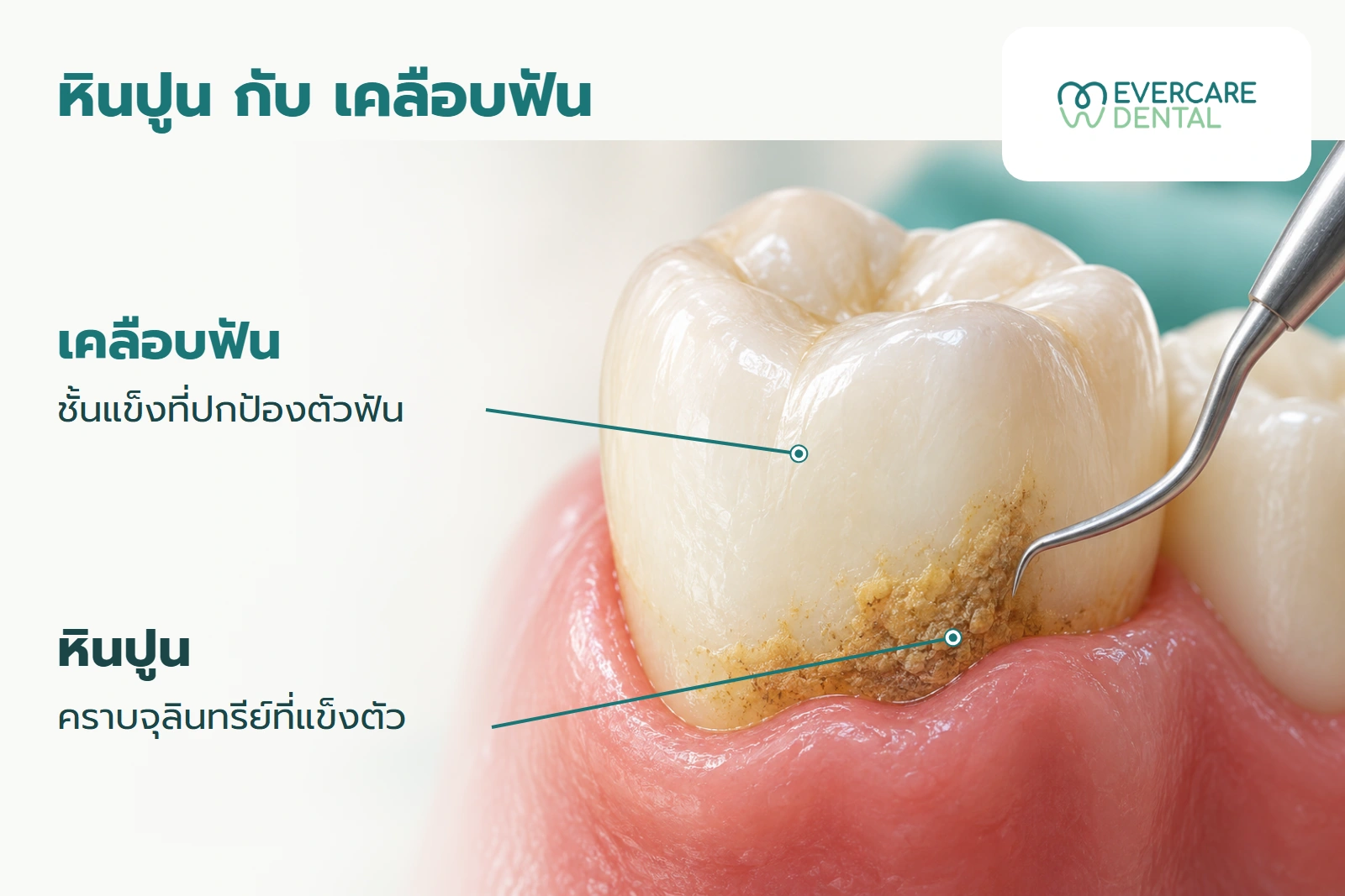 โมเดลฟันจำลองหนึ่งซี่เป็นหลัก พร้อมป้ายชี้คราบหินปูนใกล้ขอบเหงือกและผิวเคลือบฟัน ไม่ใช่ภาพตัดขวางหรือผลรักษาจริง