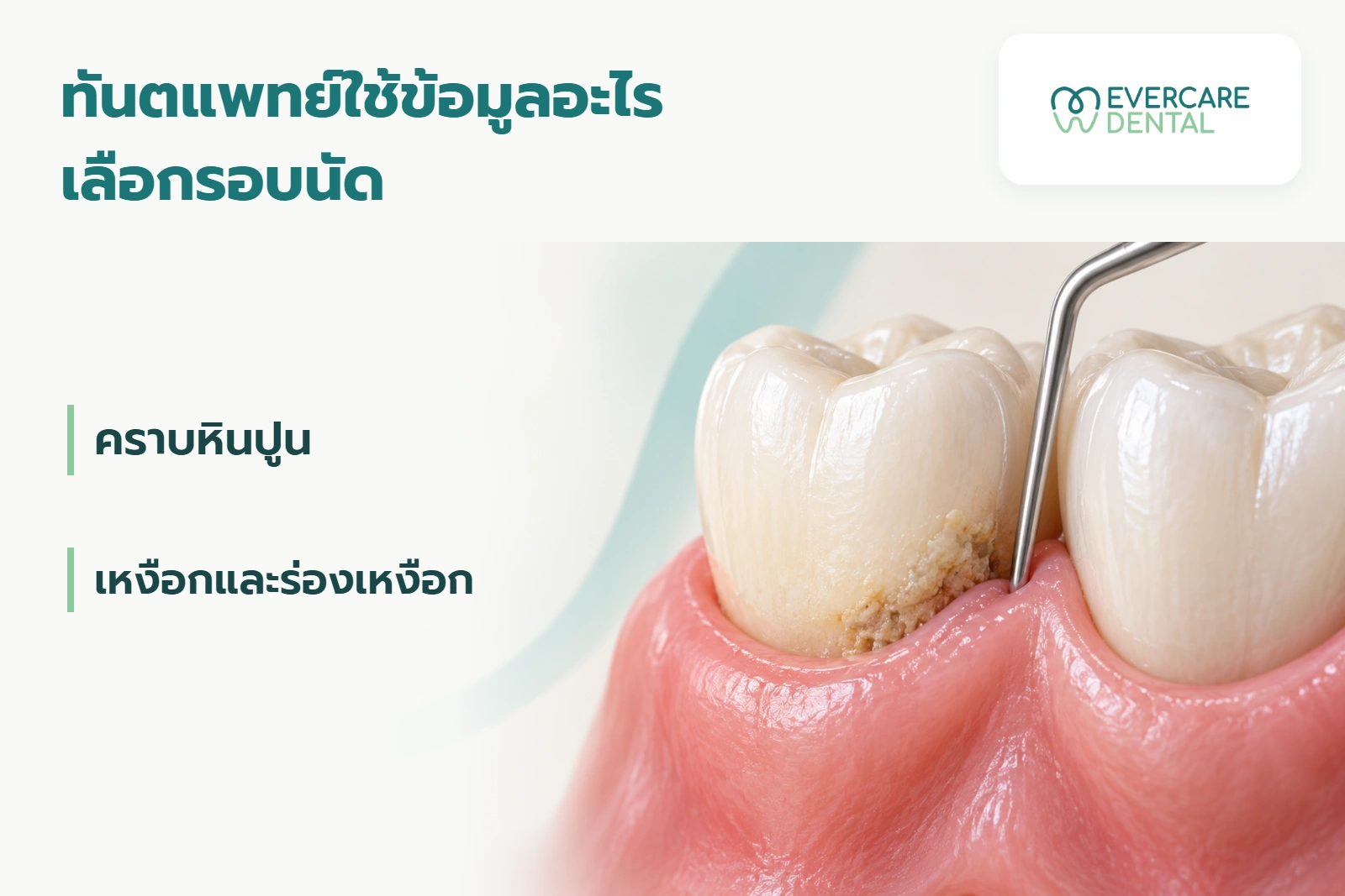 โมเดลฟันและเหงือกจำลองพร้อมคราบบริเวณขอบเหงือกและเครื่องมือตรวจ ประกอบหัวข้อข้อมูลที่ทันตแพทย์ใช้เลือกรอบนัด