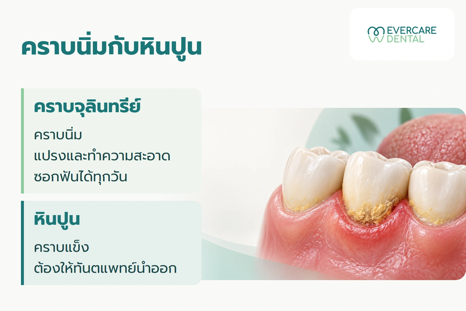 ภาพจำลองฟันสามซี่ประกอบการอธิบายความต่างของคราบจุลินทรีย์นิ่มกับหินปูนแข็ง พร้อมแนวทางทำความสะอาด