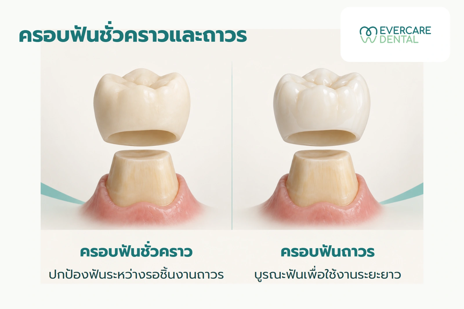 โมเดลสมมติเปรียบเทียบบทบาทครอบชั่วคราวที่ปกป้องฟันระหว่างรอ กับครอบถาวรสำหรับบูรณะระยะยาว