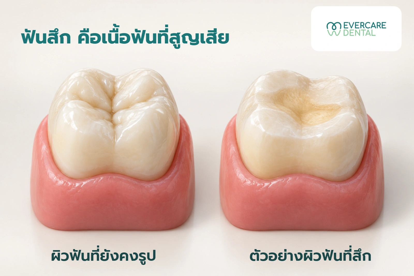 โมเดลฟันกรามสามมิติจำลองสองชิ้น เปรียบเทียบผิวฟันที่คงรูปกับตัวอย่างผิวด้านบดเคี้ยวที่สึก ไม่ใช่ภาพก่อนและหลังรักษา