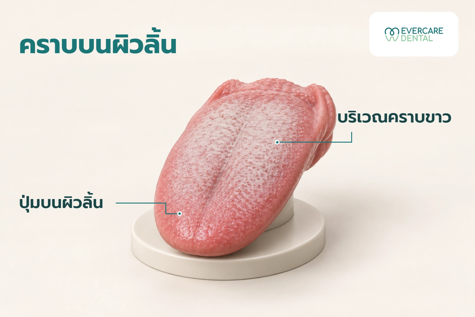 โมเดลลิ้นสามมิติเชิงแนวคิดหนึ่งชิ้น มีป้ายชี้ปุ่มบนผิวลิ้นและบริเวณคราบขาว ภาพนี้ไม่ใช้แยกสาเหตุหรือวินิจฉัยโรค