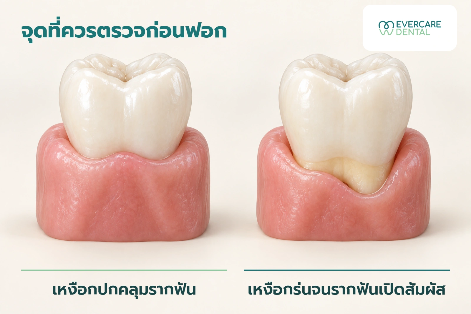 โมเดลฟันแนวคิดเปรียบเทียบเหงือกที่ปกคลุมรากกับเหงือกร่นจนรากฟันเปิดสัมผัส ซึ่งเป็นปัจจัยที่ทันตแพทย์ประเมินก่อนฟอก